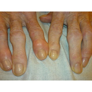 Heberden-Arthrose