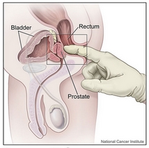 Prostata
